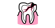 Injuries to the mouth and/or teeth can result from a fall on the face or a direct blow, such as a punch.